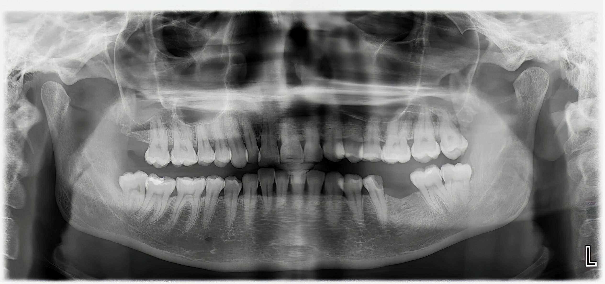 Radiographs Compressed Radiographs Compressed